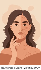 Vector illustration, half of a woman's face with acne, half with clear skin. Woman with problem skin. Topics hormonal changes skin care, dermatology, cosmetology, balance. For women's projects, health