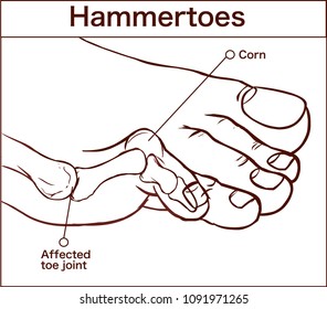 Vector Illustration Of A Hammertoe 