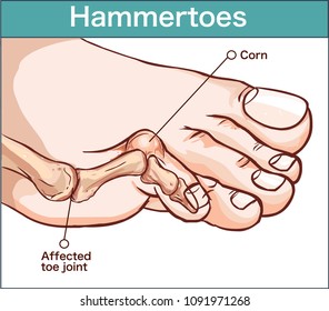 Vector Illustration Of A Hammertoe 