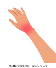 Vector illustration of hand with carpal tunnel syndrome