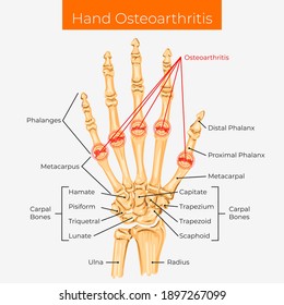 Vector illustration. Hand osteoarthritis poster.