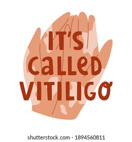 Vector illustration of hands with vitiligo skin disease. Text lettering "It's called vitiligo". Acceptance of yourself and body positive. For blog, articles, banner, design