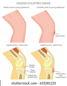 Vector illustration of a healthy adolescent knee and unhealthy knee with Osgood schlatter disease. Anatomy of human knee, external view and lateral view of  sagittal section of the knee.