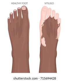 Vector illustration of a healthy Afro American foot and a foot with vitiligo, loss of skin color. Dorsal view.  For advertising, medical publications. EPS 8.