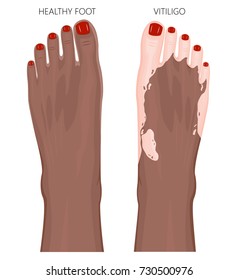 Vector illustration of a healthy Afro American foot with red toenails and a foot with vitiligo, loss of skin color. Dorsal view.  For advertising, medical publications. EPS 8.