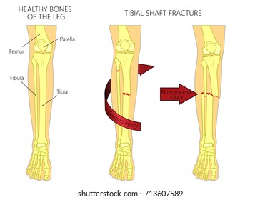 Vector illustration of a healthy bones of human leg and a leg with tibial shaft fracture. Twisting, blunt trauma injury. Front view of the foot with knee. For advertising, medical publications. EPS 10