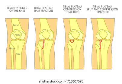 Vector illustration of a healthy bones of human knee and a knee with tibial plateau split, compression or depression fractures. Front view of the knee. For advertising, medical publications. EPS 10.