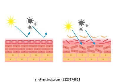 ilustración vectorial de la comparación de la anatomía cutánea sana y dañada. epidermis y desmis de la piel. ilustración para la medicina cutánea y la salud.