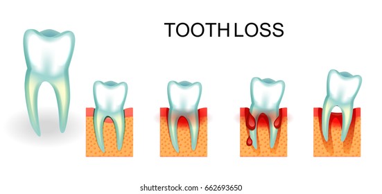 vector illustration of healthy and diseased tooth. bleeding gums. tooth loss
