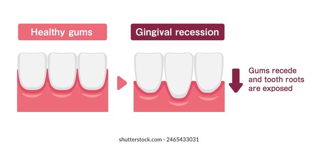 Vector illustration of healthy gums and gingival recession