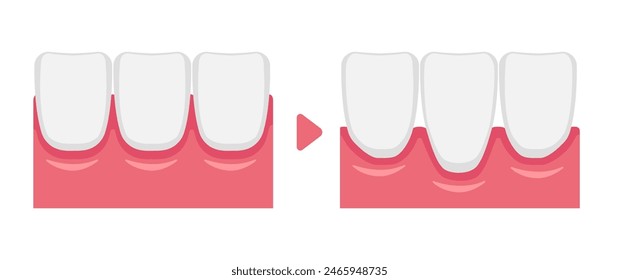 Vector illustration of healthy gums and gingival recession