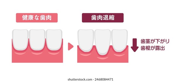 Vector illustration of healthy gums and gingival recession. Translation:  Healthy gums, Gingival recession, Gums recede and tooth roots are exposed.