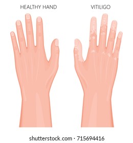 Vector illustration of a healthy hand and a hand with vitiligo, loss of skin color. Dorsal view. For advertising, medical publications. EPS 8.