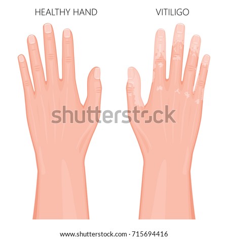 Vector illustration of a healthy hand and a hand with vitiligo, loss of skin color. Dorsal view. For advertising, medical publications. EPS 8.