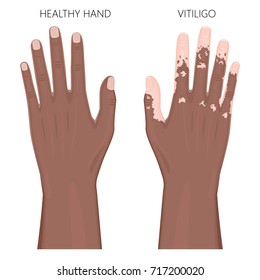 Vector illustration of a healthy human Afro American hand and a hand with vitiligo, loss of skin color, depigmentation. Dorsal view. For advertising, medical publications. EPS 8.