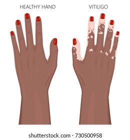 Vector illustration of a healthy human Afro American hand with colored nails and a hand with vitiligo, loss of skin color, depigmentation. Dorsal view. For advertising, medical publications. EPS 8.