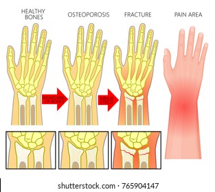 Vector illustration of a healthy human arm, with osteoporotic injury, with ulnar and radius bones fractures in spongy part and area of pain. EPS 10