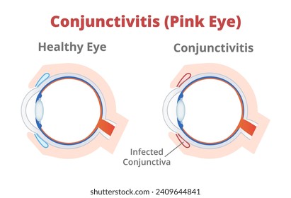 Ilustración vectorial de ojo y conjuntivitis humanos sanos o ojo rosa aislado en un fondo blanco. conjuntivitis viral o bacteriana con inflamación. Salud, enfermedad ocular, sección vertical.