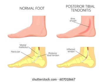 Vector illustration of  healthy human foot and a medial ankle injury. Posterior tibial tendonitis. EPS 10.