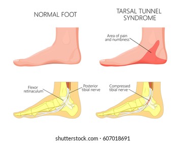 Vector illustration of  healthy human foot and a medial ankle injury. Tarsal tunnel syndrome. EPS 10.