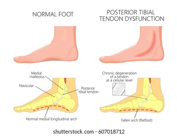 Vector illustration of  healthy human foot and a medial ankle injury. Posterior tibial tendon dysfunction. EPS 10.
