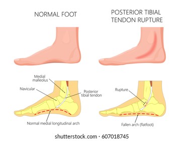 Vector Illustration Of  Healthy Human Foot And A Medial Ankle Injury. Posterior Tibial Tendon Rupture. EPS 10.