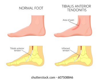 Vector illustration of  healthy human foot and a medial ankle injury. Tibialis anterior tendonitis. EPS 10.