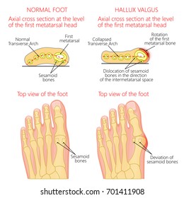 Vektorgrafik eines gesunden menschlichen Fußes und eines Fußes mit Hallux valgus, Verlagerung von Sesamoidknochen. Draufsicht und Querschnitt des Fußes. Für die Werbung, medizinische Veröffentlichungen. EPS10.