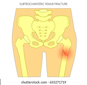 Vector illustration of healthy human hip and subtrochanteric femur fracture without dislocation. For advertising and medical publications. EPS 10 