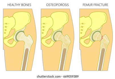 Vector illustration of a healthy human hip joint and bones,  osteoporosis of femur and femoral neck fracture without dislocation. For advertising and medical publications. EPS 10.