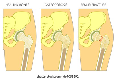 Vector illustration of a healthy human hip joint and bones,  osteoporosis of femur and femoral neck fracture with dislocation. For advertising and medical publications. EPS 10.