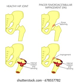 Vector illustration of a healthy human hip joint and a hip with pincer femoroacetabular impingement. Front view of hip joint. For advertising and medical publications. EPS 10.