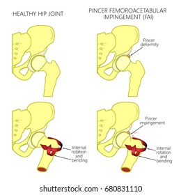 Vector illustration of a healthy human hip joint and a hip with pincer femoroacetabular impingement. Front view of hip joint. For advertising and medical publications. EPS 10.