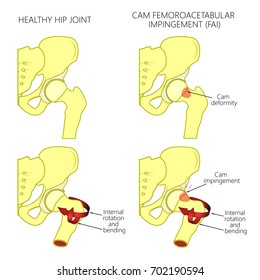 Vector illustration of a healthy human hip joint and a hip with cam femoroacetabular impingement. Front view of hip joint with section of the pelvis. For advertising and medical publications. EPS 10.
