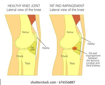 Vector illustration of a healthy human knee joint and unhealthy knee with Hoffa's fat pad impingement syndrome. Knee anatomy, lateral view. For advertising and medical publications. EPS 10.