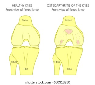 Vector illustration of a healthy human knee joint and unhealthy knee with osteoarthritis problem. Front view of bent knee. For advertising and medical publications. EPS 10. 