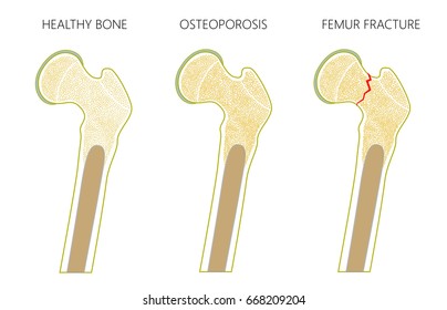 Vector illustration of a healthy human thigh bone,  osteoporosis of femur and femoral neck fracture without dislocation isolated on white background. For advertising and medical publications. EPS 10.