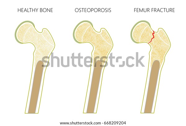 白い背景に脱臼のない健康な人の大腿骨 大腿骨骨粗しょう症 大腿頸部骨折のベクターイラスト 広告や医療出版物用 Eps10 のベクター画像素材 ロイヤリティフリー