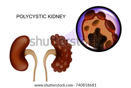 vector illustration of a healthy kidney and a kidney afflicted with polycystic