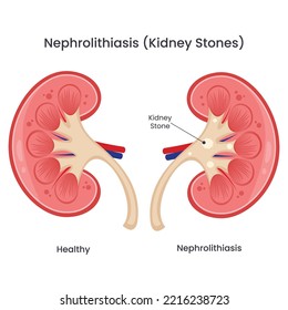 Vector illustration of a healthy kidney compared to a kidney with kidney stones