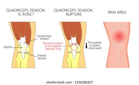 Vektorillustration-Darstellung eines gesunden Kniegelenks und eines ungesunden Knies mit einem Quadriceps-Sehnen-Rupturproblem. Anatomie, Frontansicht auf das menschliche Knie.  Für Werbung und medizinische Publikationen. EPS10.