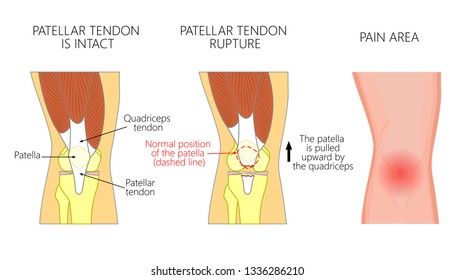 Vector illustration of a healthy knee joint and an unhealthy knee with a patellar tendon rupture problem. Anatomy, front view of the human knee.  For advertising and medical publications. EPS 10.