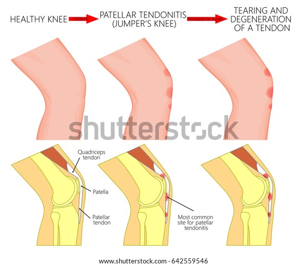 Vector Illustration Healthy Knee Joint Unhealthy Stock Vector Royalty Free 642559546 1208