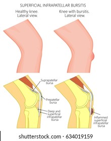 Vector illustration of a healthy knee and unhealthy knee with superficial infrapatellar bursitis or clergyman's knee. Anatomy of human knee joint, lateral or side view. EPS 10.