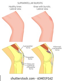 Vector illustration of a healthy knee and unhealthy knee with suprapatellar bursitis. Anatomy of human knee joint, lateral or side view. EPS 10.