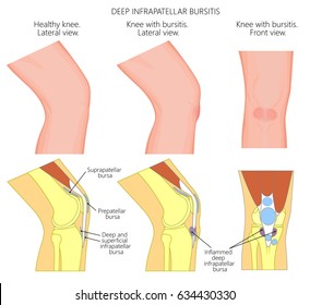 Vector illustration of a healthy knee and unhealthy knee with deep infrapatellar bursitis or clergyman's knee. Anatomy of human knee joint, lateral or side view, anterior or front view. EPS 10.