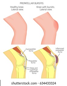 Vector illustration of a healthy knee and unhealthy knee with prepatellar bursitis or housemaid's knee. Anatomy of human knee joint, lateral or side view. EPS 10