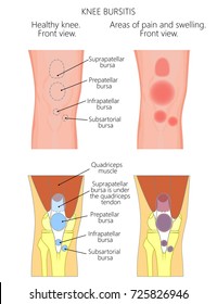 Vector illustration of a healthy knee, unhealthy knee with bursitis and areas of pain, most common types of it. Anatomy of human knee anterior, front view. For advertising, medical publications EPS 10