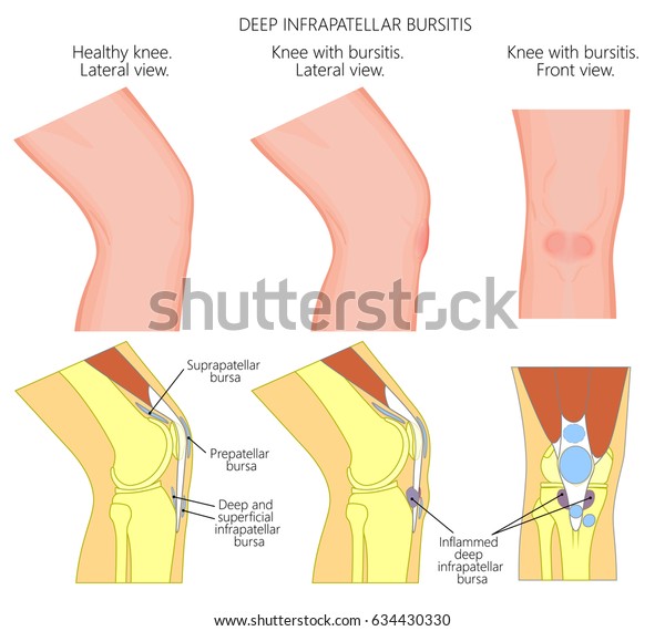 膝が健康で不健康な膝で 深い膝下滑液包炎または聖職者の膝を持つベクターイラスト 人間の膝の関節の構造 左右または側面 前面または正面図 Eps10 のベクター画像素材 ロイヤリティフリー