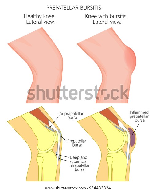 膝が健康で不健康な膝で 膝蓋滑液包炎または家政婦の膝があるベクターイラスト 人間の膝の関節 側面図 側面図の構造 Eps10 のベクター画像素材 ロイヤリティフリー